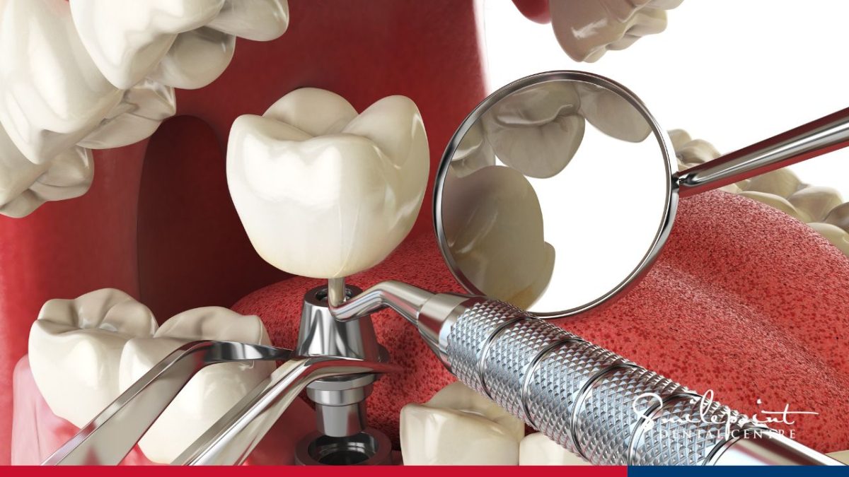 Dental implants vs Dentures: Which is right for me