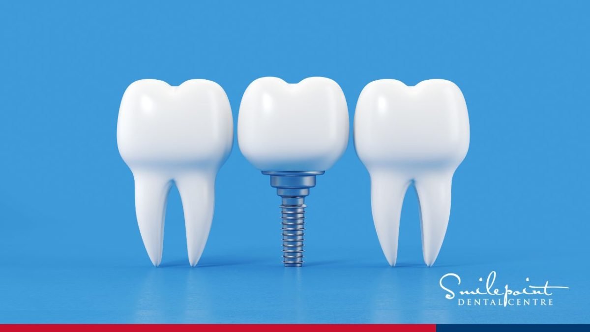 dental implant cost in singapore