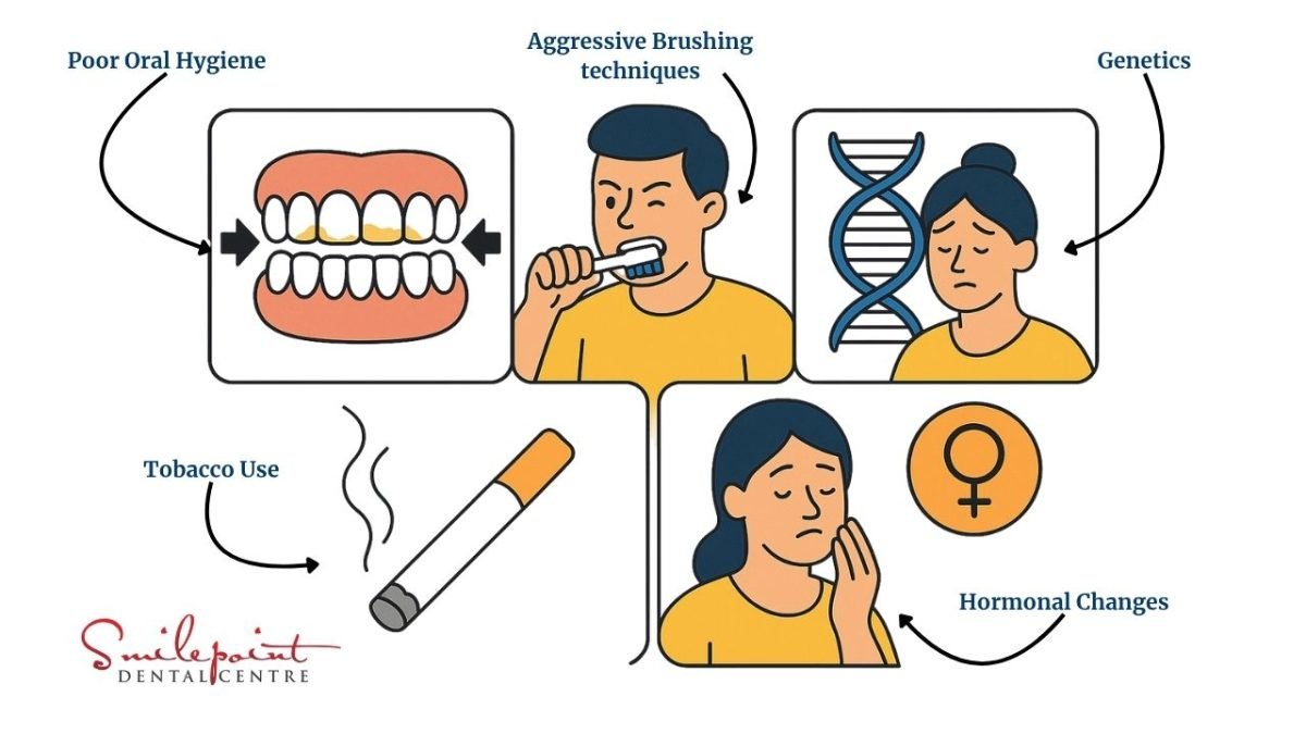 Common Known reasons of Gum Recession